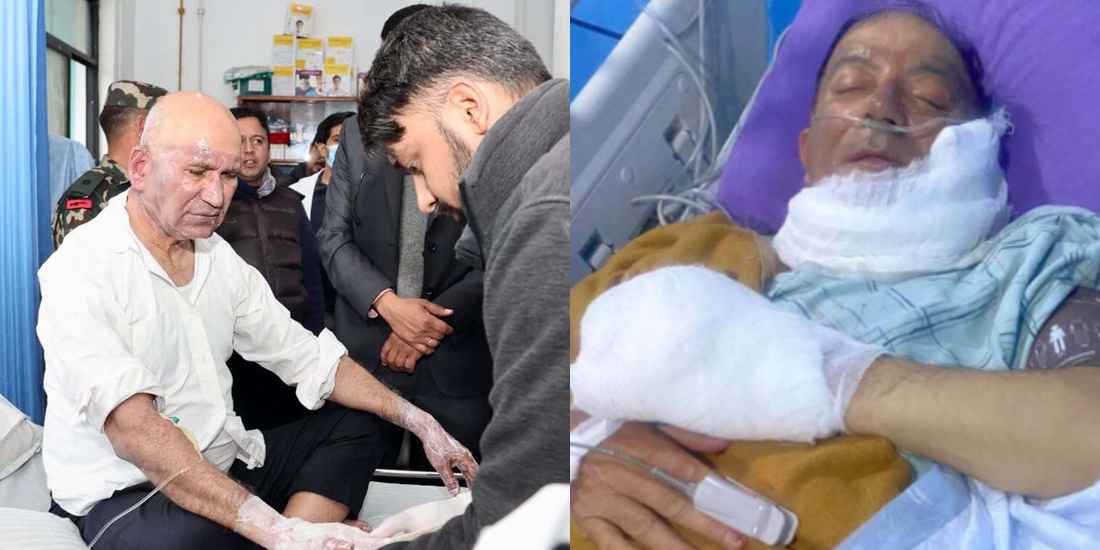 अर्थमन्त्री पौडेल र मेयर आचार्यको स्वास्थ्य सुधारोन्मुख, भेटघाट बन्द